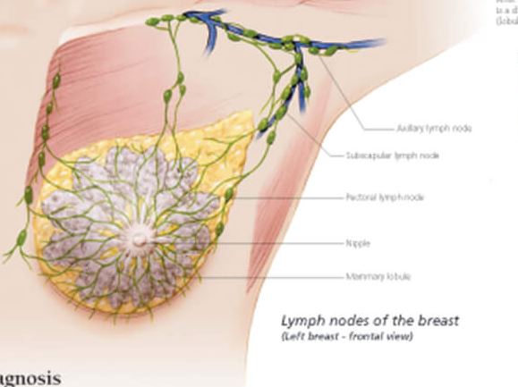 breast cancer surgeon newcastle