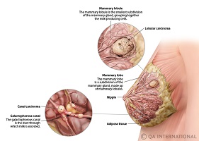 breast cancer surgeon north sydney