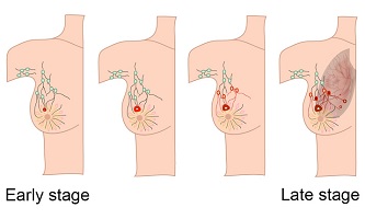 breast cancer surgeon özcan