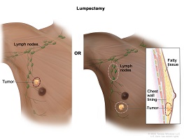 breast cancer surgeon plano