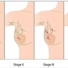 breast cancer surgeon port macquarie