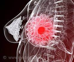 breast cancer surgeon uk