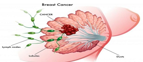 breast cancer surgeon vancouver