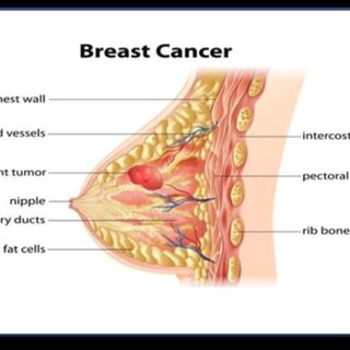 breast cancer surgeon yale