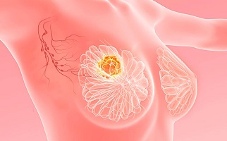 breast cancer surgeon zealand