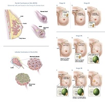 breast cancer surgeon zinc