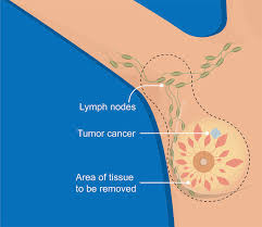 breast cancer surgeons calgary