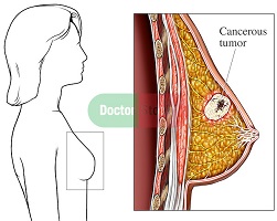 chantel breast cancer surgeon