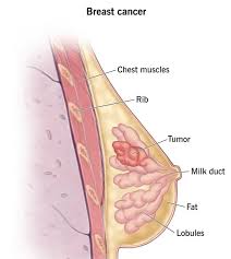 colon cancer surgeon übersetzung