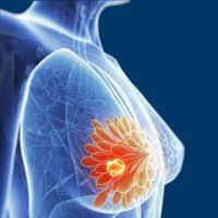 plastic surgeon for breast cancer reconstruction