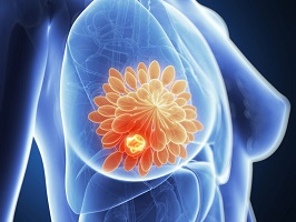 questions to ask surgeon after breast cancer diagnosis