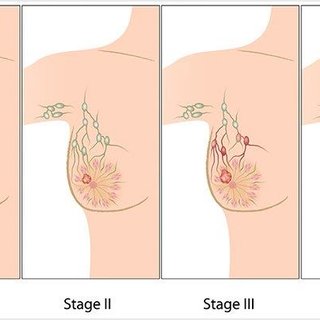 stomach cancer surgeon çin