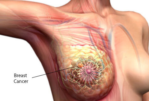 stomach cancer surgeon elden ring