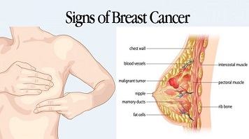 what type of surgeon does breast cancer surgery